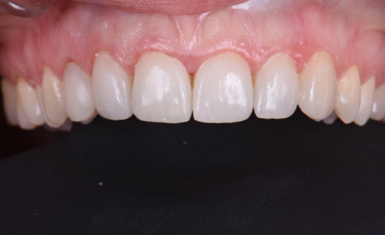 Microcarillas dentales: la clave para renovar sonrisa