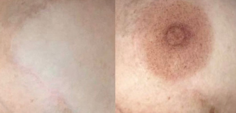 Micropigmentacion en él área de la salud: pequeños cambios que mejoran la autoestima