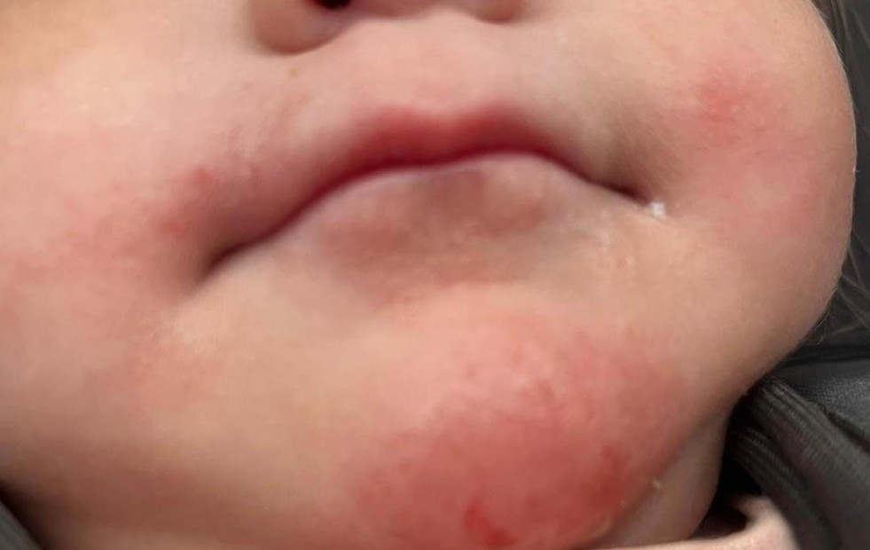 Tratar la dermatitis atópica en COS Instituto Médico
