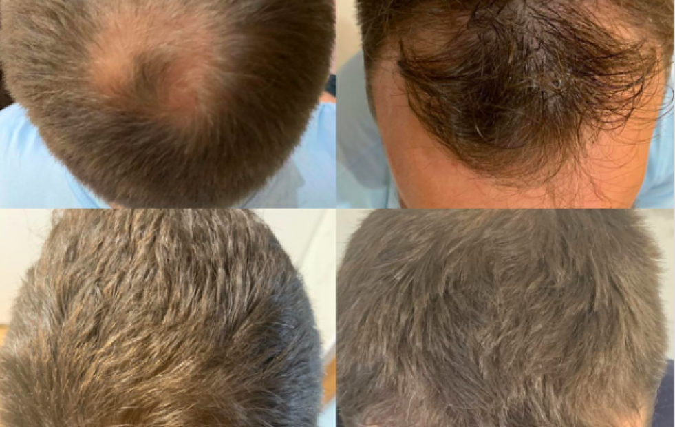Descubre la tricología: la rama de los dermatólogos especialistas en cuidado del cabello y la caída capilar